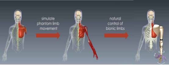 New prosthetic technology lets you control artificial arms